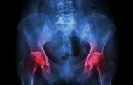 Artrosi dell'anca, sintomatologia e prevenzione (secondo step)